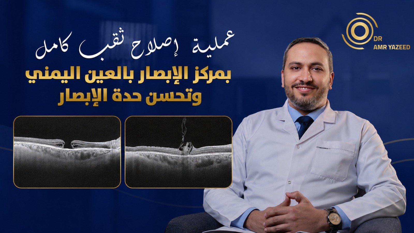 ثقب مركز الإبصار: الأسباب والأعراض وطرق العلاج الجراحي