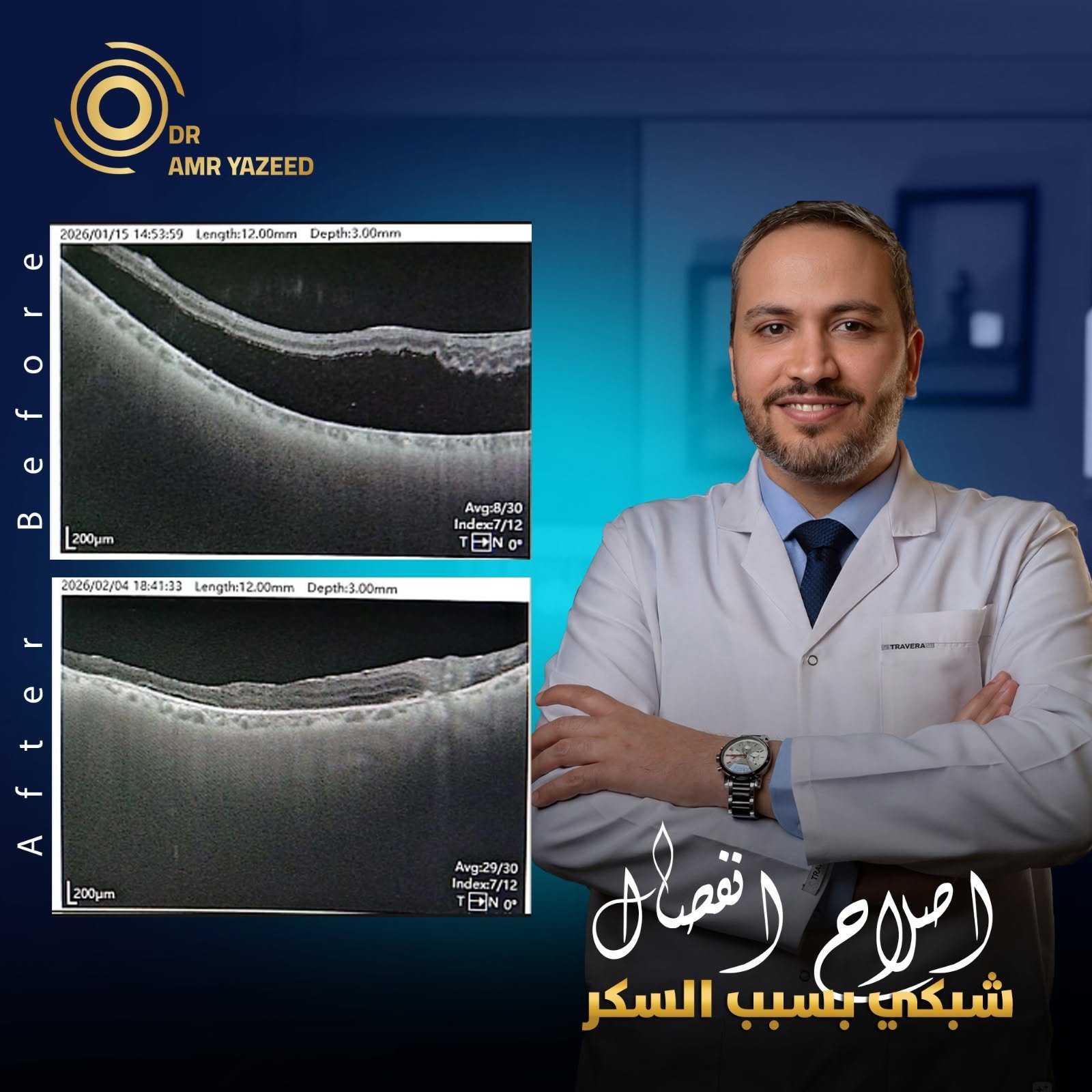 حقن شبكية العين
