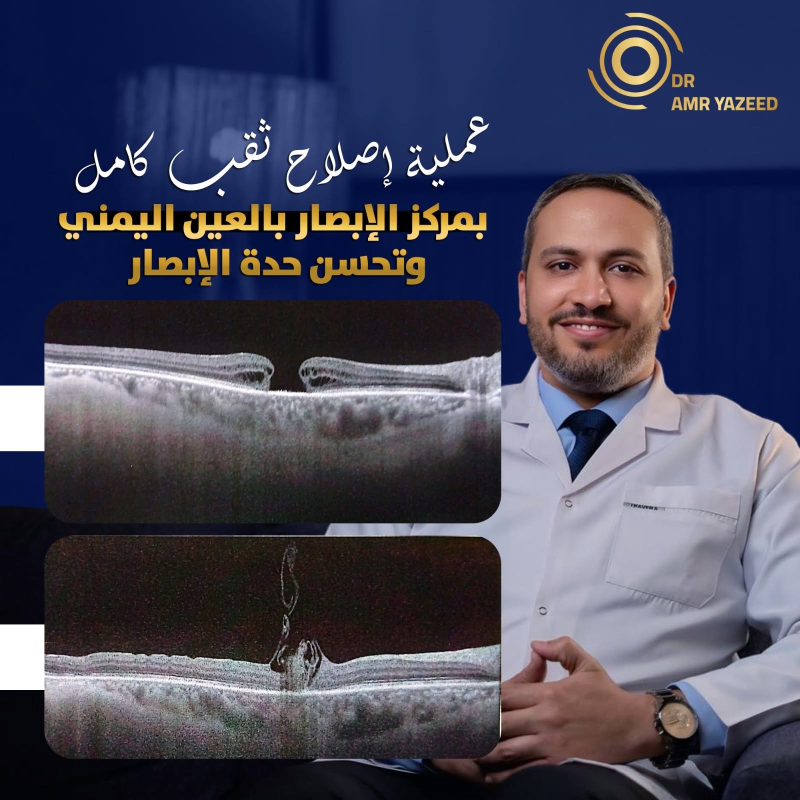 علاج شبكية العين بالليزر